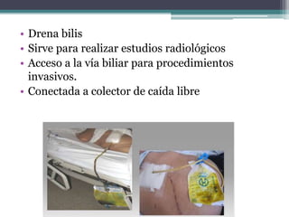 • Drena bilis
• Sirve para realizar estudios radiológicos
• Acceso a la vía biliar para procedimientos
invasivos.
• Conectada a colector de caída libre
 