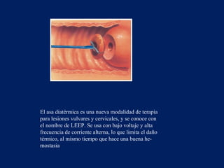 El asa diatérmica es una nueva modalidad de terapia
para lesiones vulvares y cervicales, y se conoce con
el nombre de LEEP. Se usa con bajo voltaje y alta
frecuencia de corriente alterna, lo que limita el daño
térmico, al mismo tiempo que hace una buena hemostasia