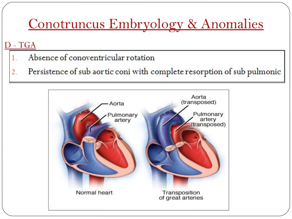 Conotruncal Anamolies