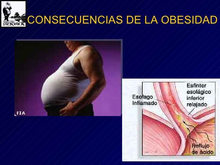 Consecuencias De La Obesidad Consecuencias De La Obesidad