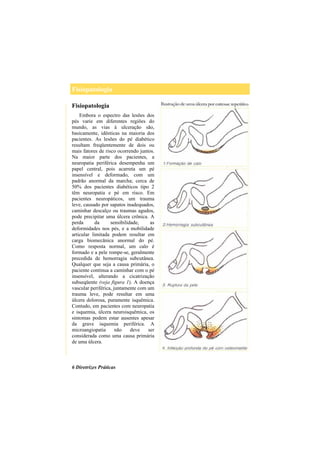 Fisiopatologia
6 Diretrizes Práticas
Fisiopatologia
Embora o espectro das lesões dos
pés varie em diferentes regiões do
mundo, as vias à ulceração são,
basicamente, idênticas na maioria dos
pacientes. As lesões do pé diabético
resultam freqüentemente de dois ou
mais fatores de risco ocorrendo juntos.
Na maior parte dos pacientes, a
neuropatia periférica desempenha um
papel central, pois acarreta um pé
insensível e deformado, com um
padrão anormal da marcha; cerca de
50% dos pacientes diabéticos tipo 2
têm neuropatia e pé em risco. Em
pacientes neuropáticos, um trauma
leve, causado por sapatos inadequados,
caminhar descalço ou traumas agudos,
pode precipitar uma úlcera crônica. A
perda da sensibilidade, as
deformidades nos pés, e a mobilidade
articular limitada podem resultar em
carga biomecânica anormal do pé.
Como resposta normal, um calo é
formado e a pele rompe-se, geralmente
precedida de hemorragia subcutânea.
Qualquer que seja a causa primária, o
paciente continua a caminhar com o pé
insensível, alterando a cicatrização
subseqüente (veja figura 1). A doença
vascular periférica, juntamente com um
trauma leve, pode resultar em uma
úlcera dolorosa, puramente isquêmica.
Contudo, em pacientes com neuropatia
e isquemia, úlcera neuroisquêmica, os
sintomas podem estar ausentes apesar
da grave isquemia periférica. A
microangiopatia não deve ser
considerada como uma causa primária
de uma úlcera.
 