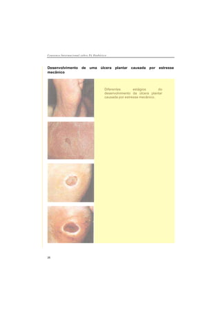 C o n s e n s o I n t e r n a c i o n a l s o b r e P é D i a b é t i c o
26
Desenvolvimento de uma úlcera plantar causada por estresse
mecânico
Diferentes estágios do
desenvolvimento da úlcera plantar
causada por estresse mecânico.
 
