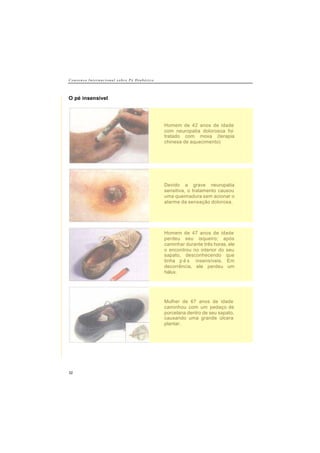 C o n s e n s o I n t e r n a c i o n a l s o b r e P é D i a b é t i c o
32
O pé insensível
Homem de 42 anos de idade
com neuropatia dolorosoa foi
tratado com moxa (terapia
chinesa de aquecimento)
Devido a grave neuropatia
sensitiva, o tratamento causou
uma queimadura sem acionar o
alarme da sensação dolorosa.
Homem de 47 anos de idade
perdeu seu isqueiro; após
caminhar durante três horas, ele
o encontrou no interior do seu
sapato, desconhecendo que
tinha p é s insensíveis. Em
decorrência, ele perdeu um
hálux.
Mulher de 67 anos de idade
caminhou com um pedaço de
porcelana dentro de seu sapato,
causando uma grande úlcera
plantar.
 