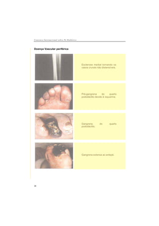 C o n s e n s o I n t e r n a c i o n a l s o b r e P é D i a b é t i c o
34
Doença Vascular periférica
Esclerose medial tornando os
vasos crurais não distensíveis.
Pré-gangrena do quarto
pododáctilo devido à isquemia.
Gangrena do quarto
pododáctilo.
Gangrena extensa ao antepé.
 