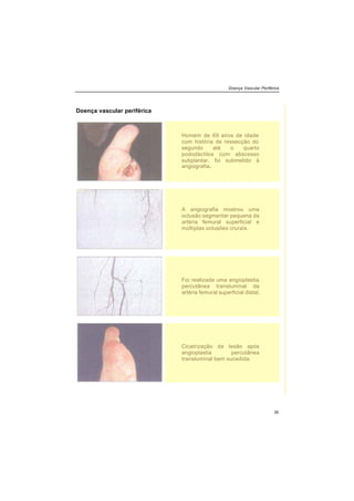 Doença Vascular Periférica
35
Doença vascular periférica
Homem de 69 anos de idade
com história de ressecção do
segundo até o quarto
pododáctilos com abscesso
subplantar, foi submetido à
angiografia.
A angiografia mostrou uma
oclusão segmentar pequena da
artéria femural superficial e
múltiplas oclusões crurais.
Foi realizada uma angioplastia
percutânea transluminal da
artéria femural superficial distal.
Cicatrização da lesão após
angioplastia percutânea
transluminal bem sucedida.
 