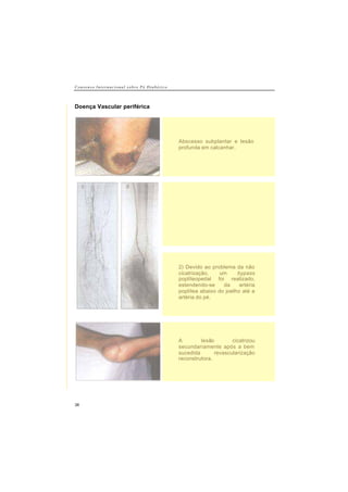 C o n s e n s o I n t e r n a c i o n a l s o b r e P é D i a b é t i c o
38
Doença Vascular periférica
Abscesso subplantar e lesão
profunda em calcanhar.
2) Devido ao problema da não
cicatrização, um bypass
poplíteopedal foi realizado,
estendendo-se da artéria
poplítea abaixo do joelho até a
artéria do pé.
A lesão cicatrizou
secundariamente após a bem
sucedida revascularização
reconstrutora.
 