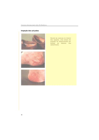 C o n s e n s o I n t e r n a c i o n a l s o b r e P é D i a b é t i c o
46
Inspeção dos calçados
Devido às costuras no interior
dos sapatos, uma úlcera de
pressão foi desenvolvida em
ambas as laterais dos
calcanhares.
 
