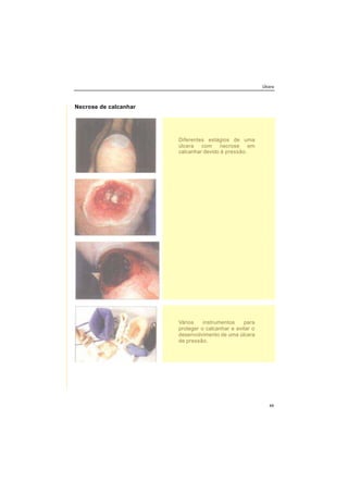 Úlcera
49
Necrose de calcanhar
Diferentes estágios de uma
úlcera com necrose em
calcanhar devido á pressão.
Vários instrumentos para
proteger o calcanhar e evitar o
desenvolvimento de uma úlcera
de pressão.
 