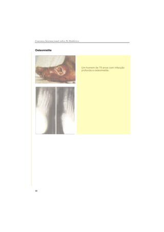 C o n s e n s o I n t e r n a c i o n a l s o b r e P é D i a b é t i c o
58
Osteomielite
Um homem de 75 anos com infecção
profunda e osteomielite.
 