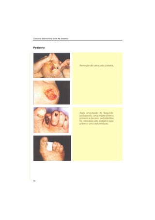 Consenso Internacional sobre Pé Diabético
70
Podiatria
Remoção de calos pelo podiatra.
Após amputação do Segundo
pododáctilo, uma órtese entre o
primeiro e terceiro pododáctilos
foi colocada pelo podiatra para
prevenir uma deformidade.
 