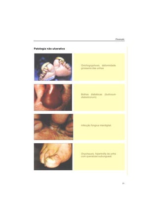 Prevenção
71
Patologia não ulcerativa
Onichogryphosis, deformidade
grosseira das unhas
Bolhas diabéticas (bullosum
diabeticorurn).
Infecção fúngica interdigital.
Onychauxis, hipertrofia da unha
com queratose subungueal.
 