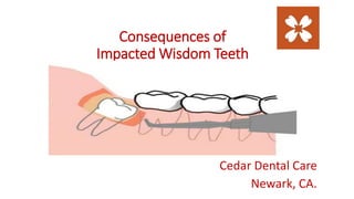 Consequences of
Impacted Wisdom Teeth
Cedar Dental Care
Newark, CA.
 