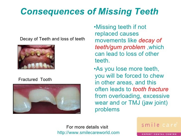 Consequences of missing teeth