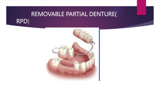 Tooth Lrpd CONSEQUENCES OF TOOTH LOSS.pptx