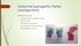 Horizontal Supraglottic Partial
Laryngectomy
 Parts removed
 Epiglotis and Pre-epiglottic space
 Hyoid bone
 Thyrohyoid membrane
 Upper half of thyroid cartilage
 Supraglottic mucosa
 
