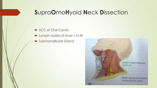 SupraOmoHyoid Neck Dissection
 SCC of Oral Cavity
 Lymph nodes of level I to III
 Submandibular Gland
 