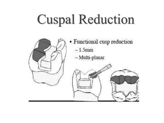 Cuspal Protection inlays&onlays | PPTX