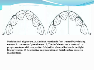 Position and alignment. A, A minor rotation is first treated by reducing
enamel in the area of prominence. B, The deficient area is restored to
proper contour with composite. C, Maxillary lateral incisor is in slight
linguoversion. D, Restorative augmentation of facial surface corrects
malposition.
 
