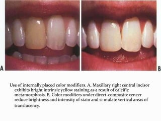 Use of internally placed color modifiers. A, Maxillary right central incisor
  exhibits bright intrinsic yellow staining as a result of calcific
  metamorphosis. B, Color modifiers under direct-composite veneer
  reduce brightness and intensity of stain and si mulate vertical areas of
  translucency.
 