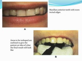 Maxillary anterior teeth with worn
                             incisal edges




Areas to be reshaped are
outlined to give the
patient an idea of what
the final result will look
like
 