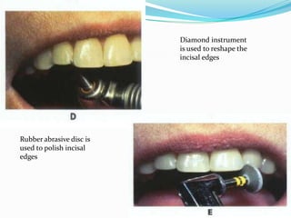 Diamond instrument
                          is used to reshape the
                          incisal edges




Rubber abrasive disc is
used to polish incisal
edges
 