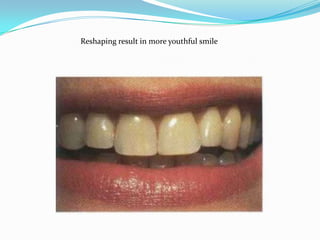 Reshaping result in more youthful smile
 