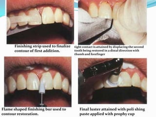 Finishing strip used to finalize   tight contact is attained by displacing the second
      contour of first addition.         tooth being restored in a distal direction with
                                         thumb and forefinger




Flame shaped finishing bur used to          Final luster attained with poli shing
contour restoration.                        paste applied with prophy cup
 
