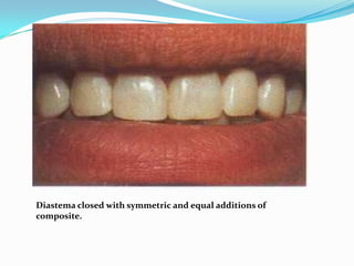 Diastema closed with symmetric and equal additions of
composite.
 