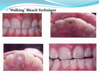  "Walking" Bleach Technique
 