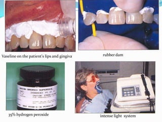 Vaseline on the patient's lips and gingiva    rubber dam




    35% hydrogen peroxide                    intense light system
 