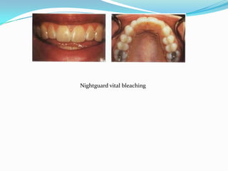 Nightguard vital bleaching
 