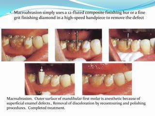  Macroabrasion simply uses a 12-fluted composite finishing bur or a fine
    grit finishing diamond in a high-speed handpiece to remove the defect




Macroabrasion. Outer surface of mandibular first molar is anesthetic because of
superficial enamel defects., Removal of discoloration by recontouring and polishing
procedures. Completed treatment.
 