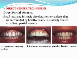  DIRECT VENEER TECHNIQUES
  Direct Partial Veneers.
  Small localized intrinsic discolorations or defects that
   are surrounded by healthy enamel are ideally treated
   with direct partial veneers




localized white spots are   Intraenamel preparations completed partial veneers
evident
 