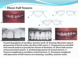 Direct Full Veneers




Enamel hypoplasia of maxillary anterior teeth. B, Drawing illustrates typical
preparation of facial surface for direct full veneer. C, Preparation is extended
onto mesial surface to provide for closure of diastema. D, Direct full veneers
restore proximal contact. E, Etched preparations of central incisors. F,
Veneers completed on maxillary central incisors. G, Treatment completed
with placement of full veneers on remaining maxillary anterior teeth.
 