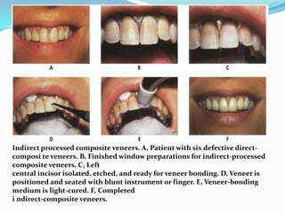 Indirect processed composite veneers. A, Patient with six defective direct-
composi te veneers. B, Finished window preparations for indirect-processed
composite veneers. C, Left
central incisor isolated, etched, and ready for veneer bonding. D, Veneer is
positioned and seated with blunt instrument or finger. E, Veneer-bonding
medium is light-cured. F, Completed
i ndirect-composite veneers.
 