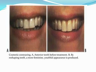 Cosmetic contouring. A, Anterior teeth before treatment. B, By
reshaping teeth, a more feminine, youthful appearance is produced.
 