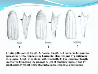 Creating illusions of length. A, Normal length. B, A tooth can be made to
appear shorter by emphasizing horizontal elements and by positioning
the gingival height of contour further incisally. C, The illusion of length
is achieved by moving the gingival height of contour gingivally and by
emphasizing vertical elements, such as developmental depressions.
 