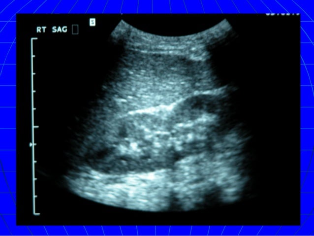 blunt injury abdomen dissertation