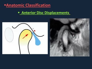 Conservative management of temporomandibular disorders | PDF