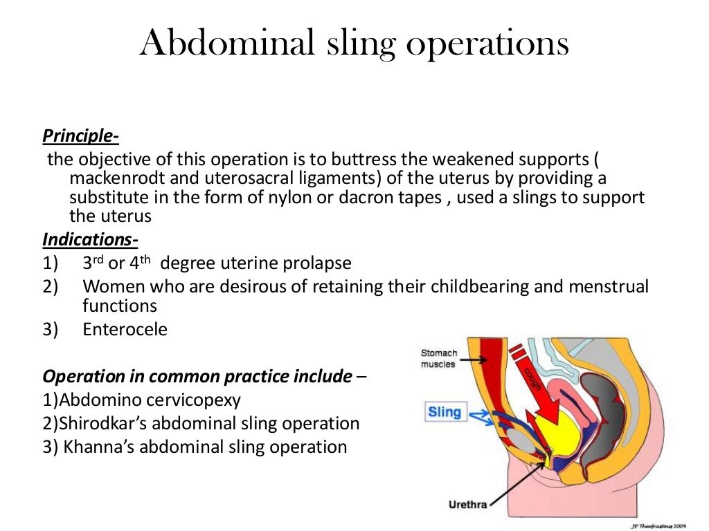Conservative surgeries for genital prolapse