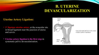 Devascularization Lecture on “Conservative Management of PPH Vs Caesarean Hysterectomy ...