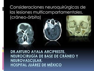 DR.ARTURO AYALA ARCIPRESTE.
NEUROCIRUGÍA DE BASE DE CRÁNEO Y
NEUROVASCULAR.
HOSPITAL JUÁREZ DE MÉXICO
Consideraciones neuroquirúrgicas de
las lesiones multicompartamentales.
(cráneo-órbita)
 