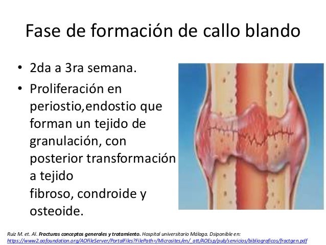 Consolidación fracturas