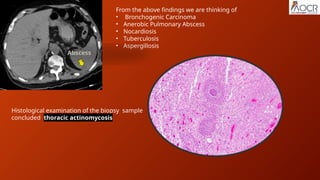 CONSOLIDATION poster in radiologyy .pptx