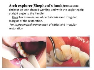Arch explorer(Shepherd’s hook):Has a semi
circle or an arch shaped working end with the exploring tip
at right angle to the handle.
Uses:For examination of dental caries and irregular
margins of the restoration.
For supragingival examination of caries and irregular
restoration
 