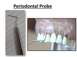 Periodontal Probe
 