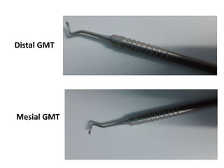 Distal GMT
Mesial GMT
 