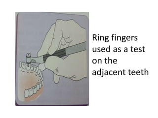 Ring fingers
used as a test
on the
adjacent teeth
 