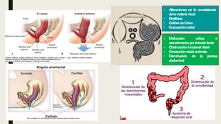 • Alteraciones en la consistencia
delamateria fecal
• Motilidad
• CalibredeColon
• Evacuaciónrectal
• Disfunción cólica o
estreñimiento portránsitolento
• Obstrucciónfuncional distal
• Percepciónrectalanómala
• Disminución de la prensa
abdominal
 