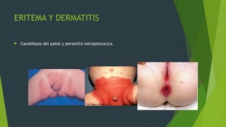 ERITEMA Y DERMATITIS
 Candidiasis del pañal y perianitis estreptococica.
 